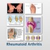 rheumatoid-arthritis.jpg